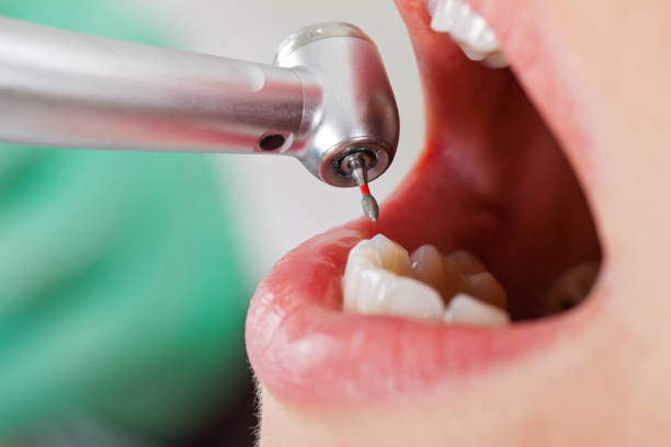 Best Emergency Root Canal Treatment in Woodland Beach, MI